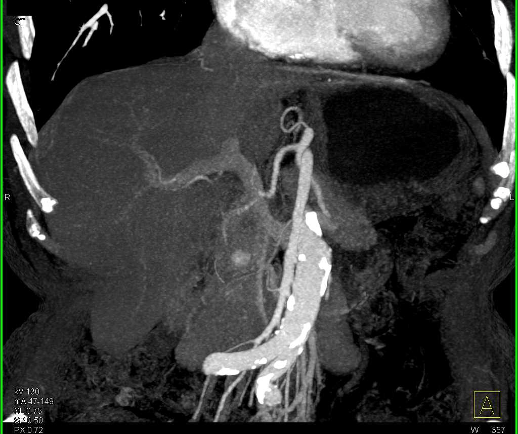 1cm Pancreatic Neuroendocrine Tumor (PNET) - CTisus CT Scan
