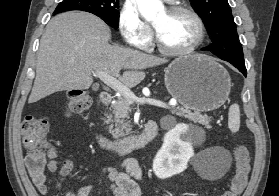2cm Carcinoma Head of Pancreas - CTisus CT Scan