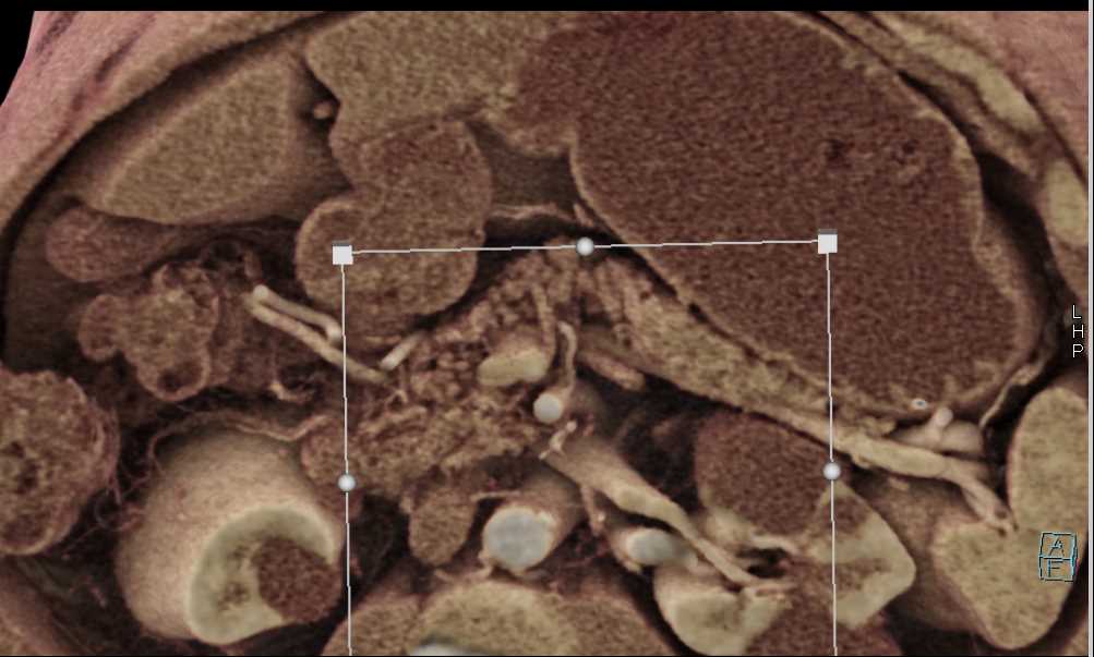 Subtle Adenocarcinoma Pancreas - CTisus CT Scan