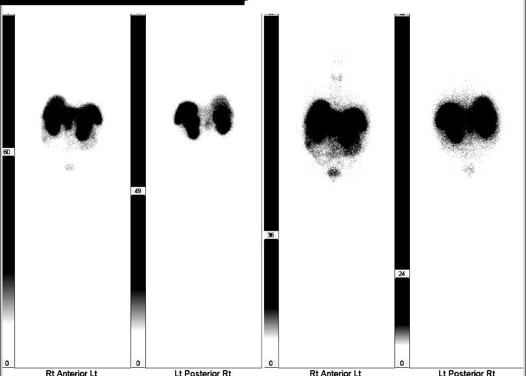 Subtle Adenocarcinoma Pancreas - CTisus CT Scan