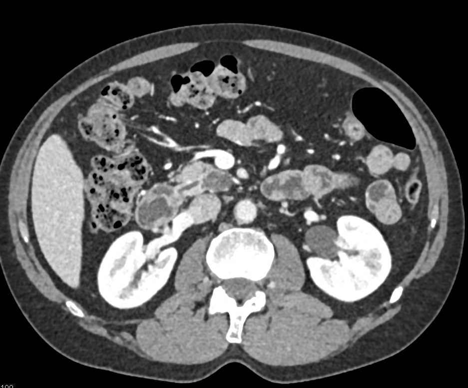 Intraductal Papillary Mucinous Neoplasm (IPMN) Head of Pancreas - CTisus CT Scan