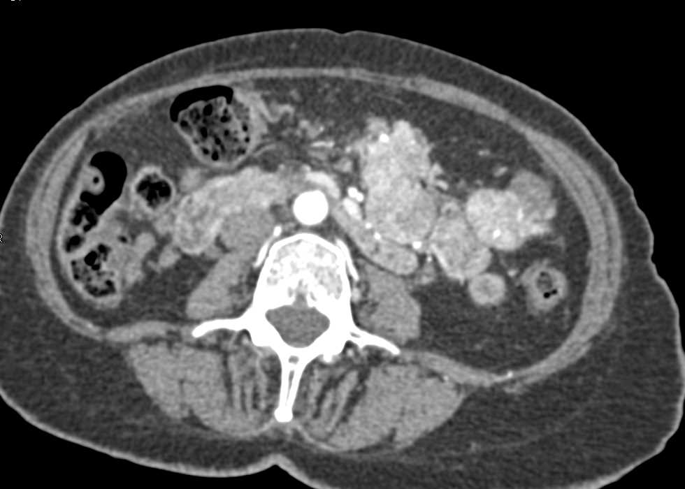 Neuroendocrine Tumor with Superior Mesenteric Vein (SMV) Occlusion - CTisus CT Scan