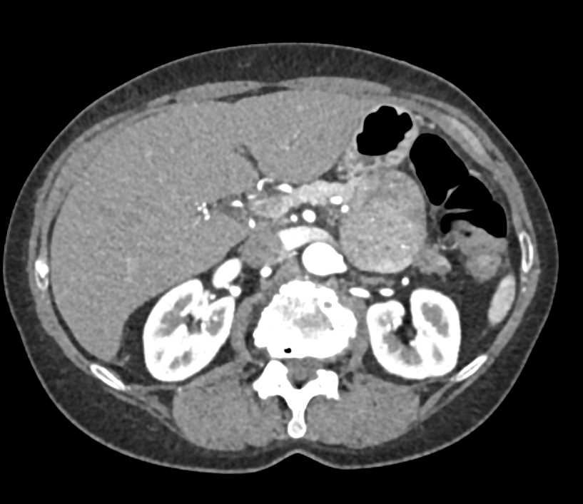 Solid Serous Cystadenoma of the Pancreas - CTisus CT Scan
