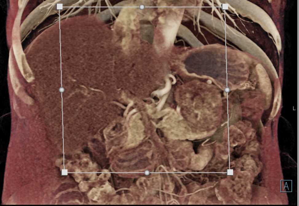 Solid Serous Cystadenoma of the Pancreas - CTisus CT Scan
