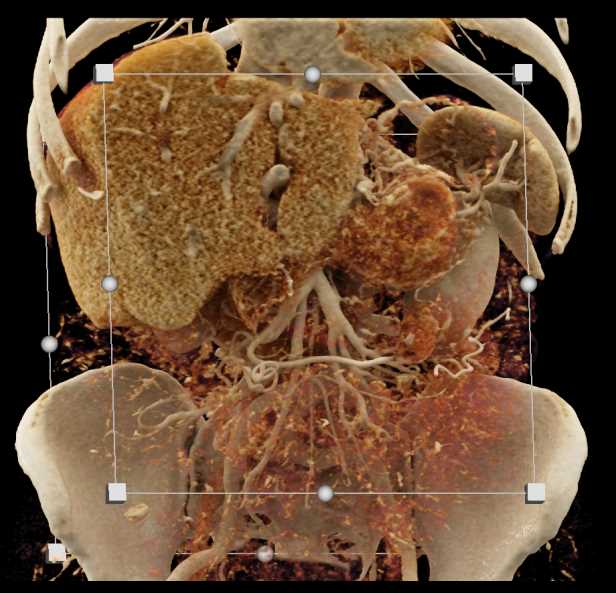 Solid Serous Cystadenoma of the Pancreas - CTisus CT Scan