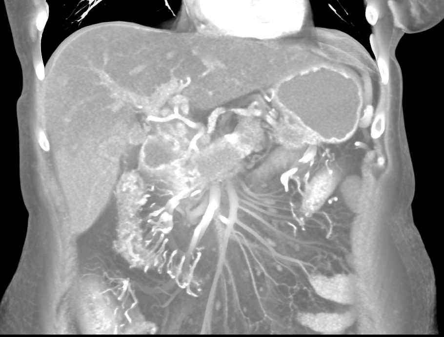 Pancreatic Cancer with Vessel Encasement and Involvement of the Transverse Colon seen - CTisus CT Scan