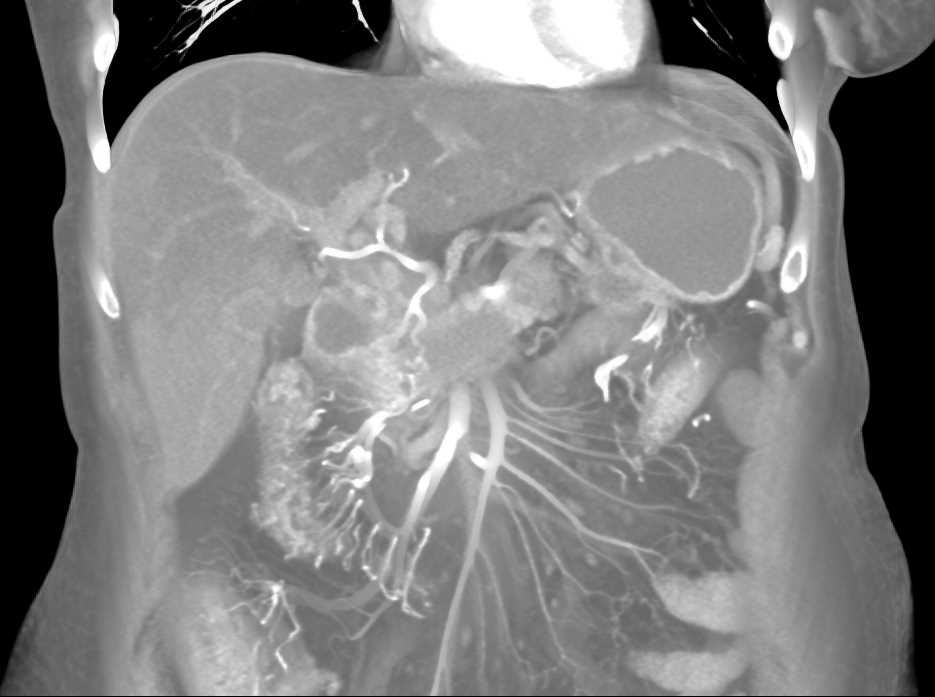 Pancreatic Cancer with Vessel Encasement and Involvement of the Transverse Colon seen - CTisus CT Scan