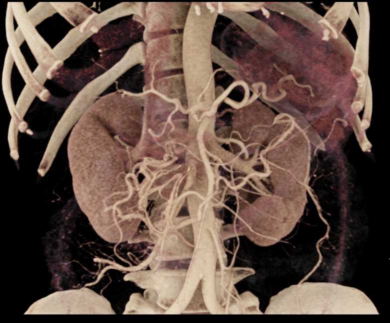 Pancreatic Cancer with Vessel Encasement - CTisus CT Scan