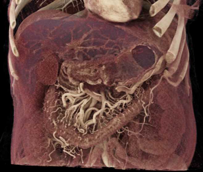 Invasive Pancreatic Adenocarcinoma - CTisus CT Scan