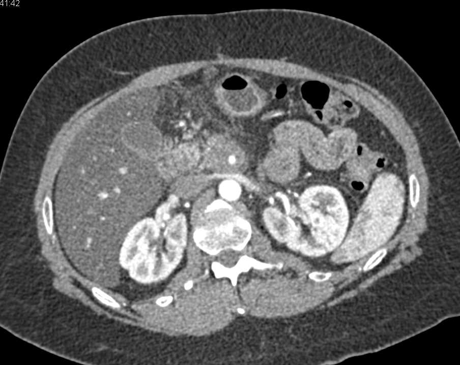 Invasive Pancreatic Adenocarcinoma - CTisus CT Scan