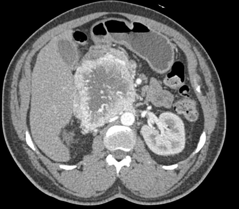 Pancreatic Neuroendocrine Tumor - CTisus CT Scan