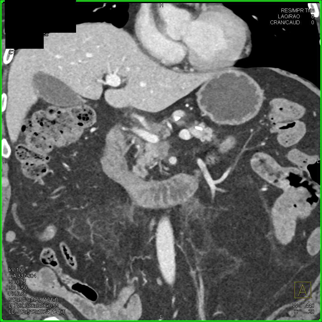 Carcinoma Head of the Pancreas - CTisus CT Scan