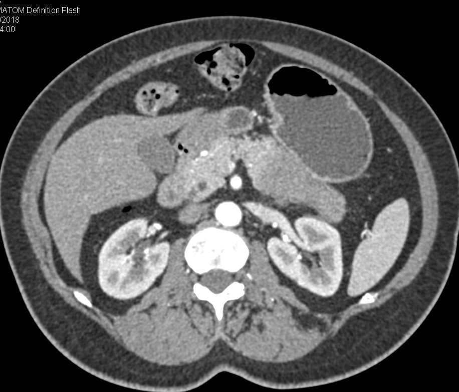 Carcinoma Tail of Pancreas - CTisus CT Scan