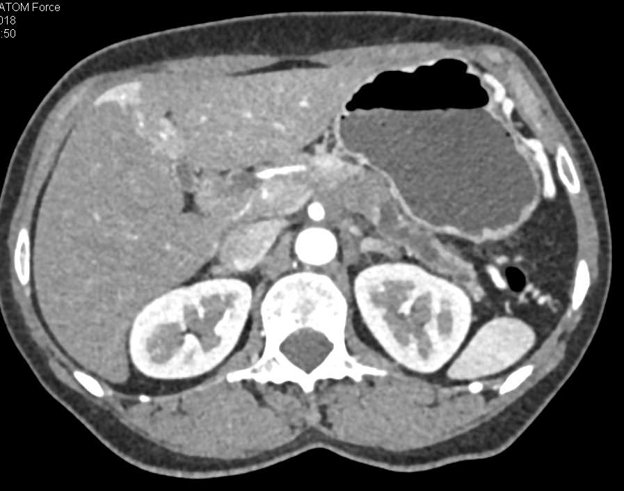 Pancreatic Cancer - CTisus CT Scan