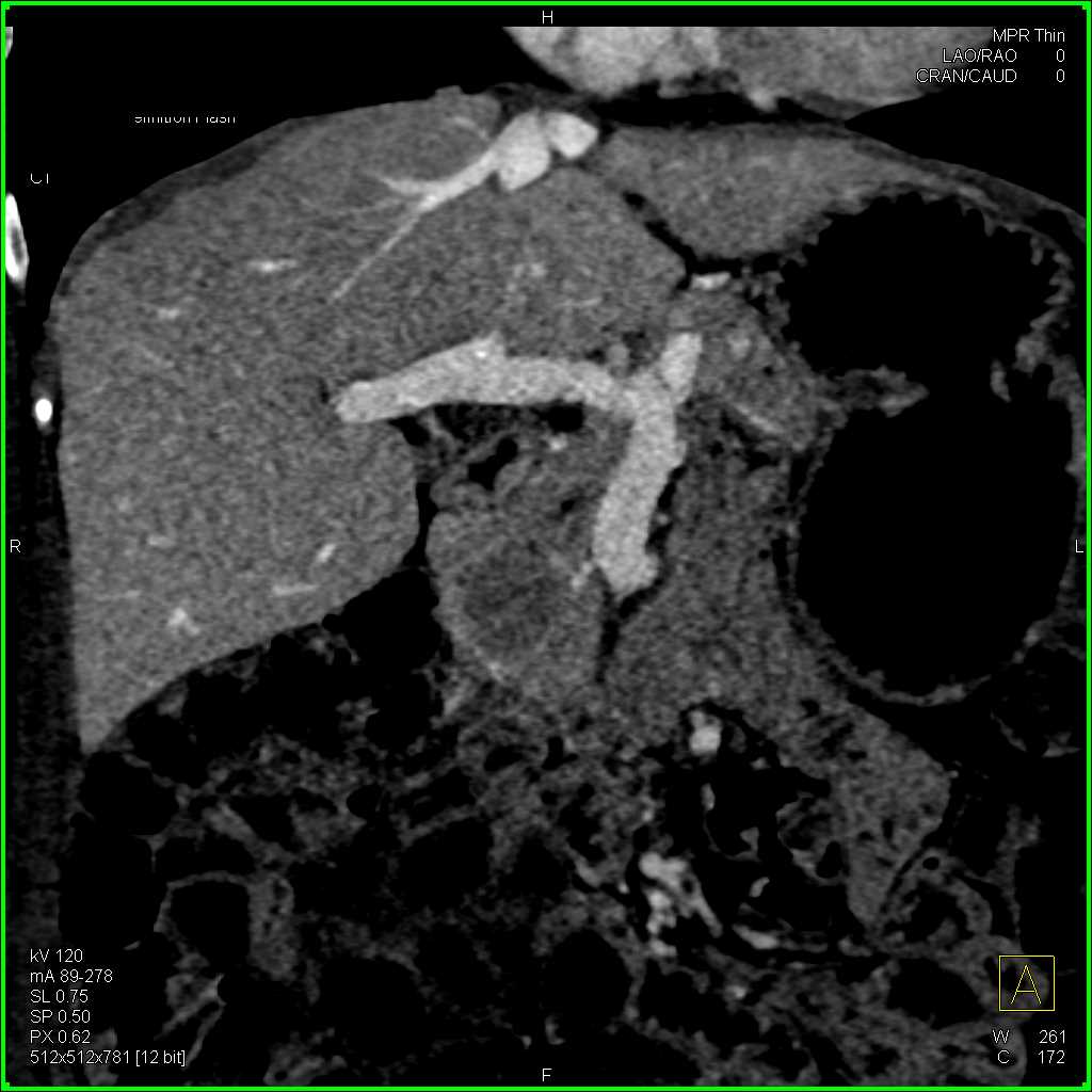 IPMN with High Grade Dysplasia - CTisus CT Scan