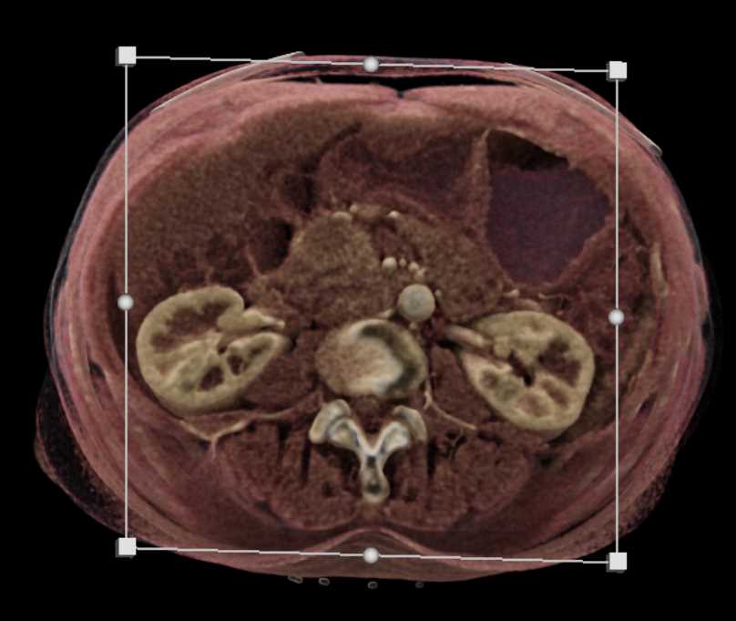 IPMN with High Grade Dysplasia - CTisus CT Scan