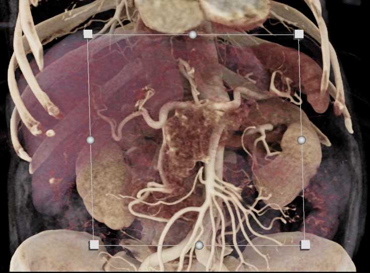 Serous Cystadenoma - CTisus CT Scan