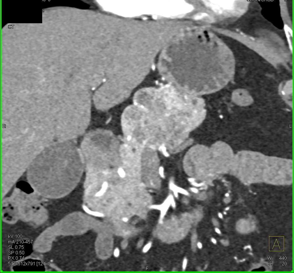 Serous Cystadenoma - CTisus CT Scan