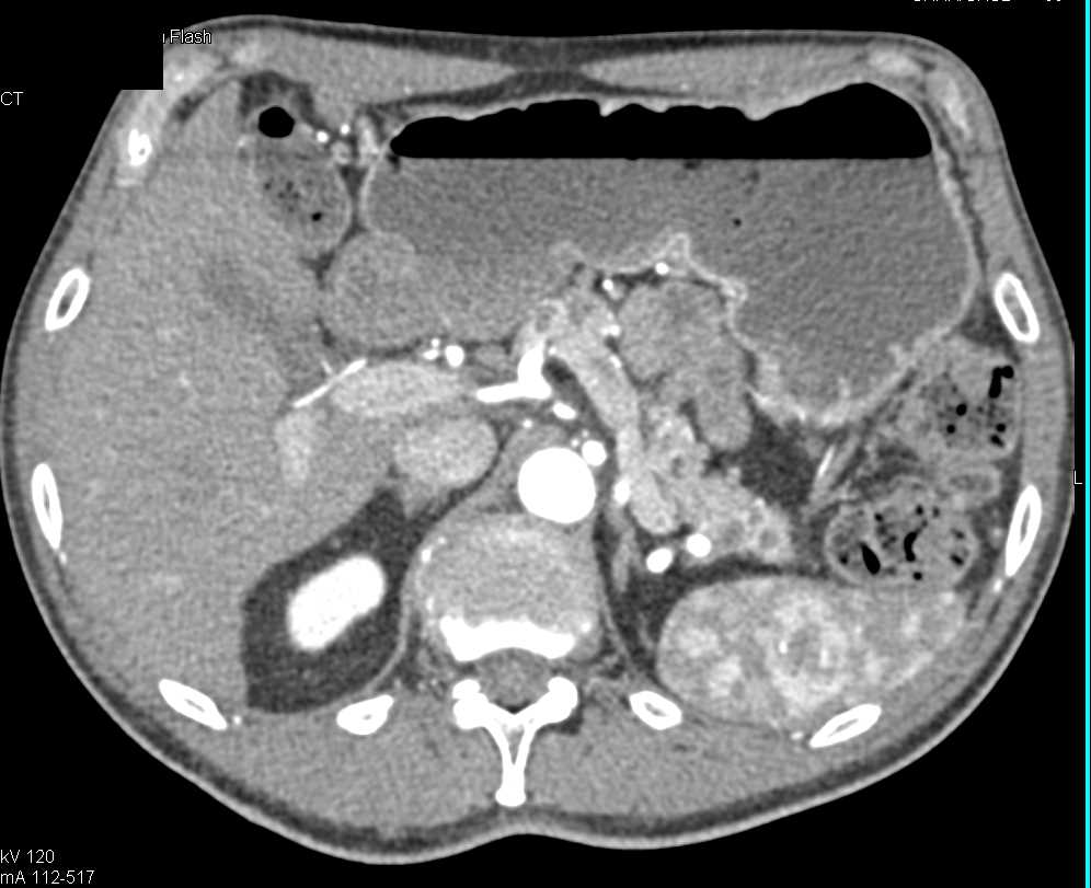 Multiple IPMNs - CTisus CT Scan