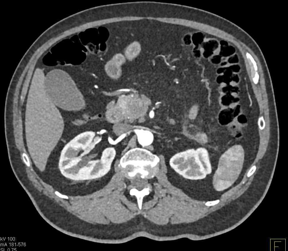 Carcinoma Head of Pancreas - CTisus CT Scan