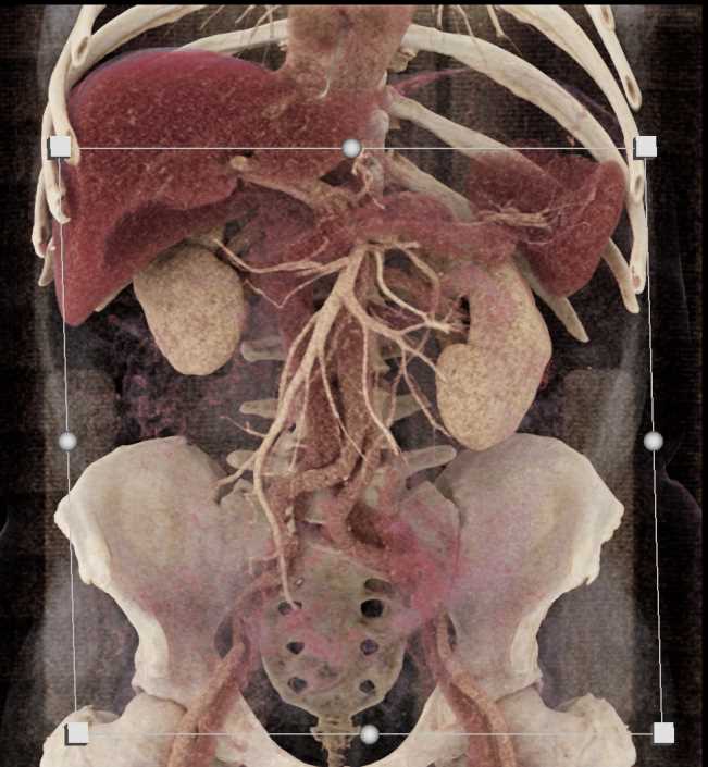 Carcinoma Head of Pancreas with vascular Mapping - CTisus CT Scan