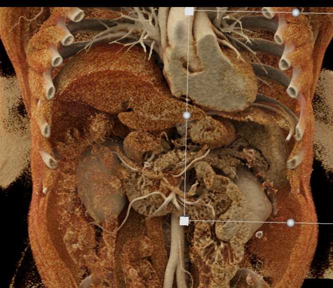 Pancreatic Cancer - CTisus CT Scan