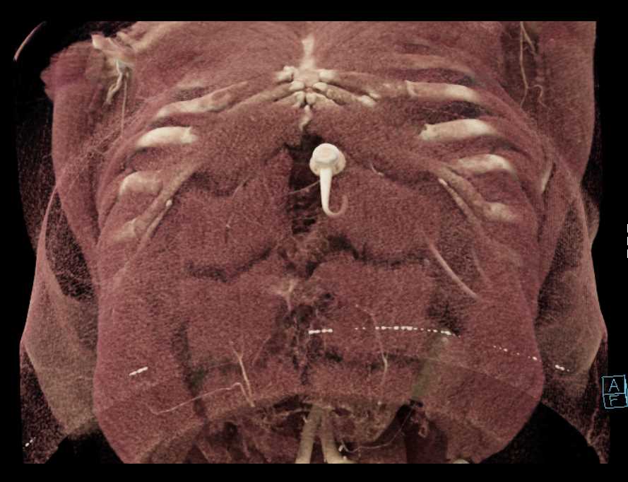 Pancreatic Cancer Involves the SMA - CTisus CT Scan