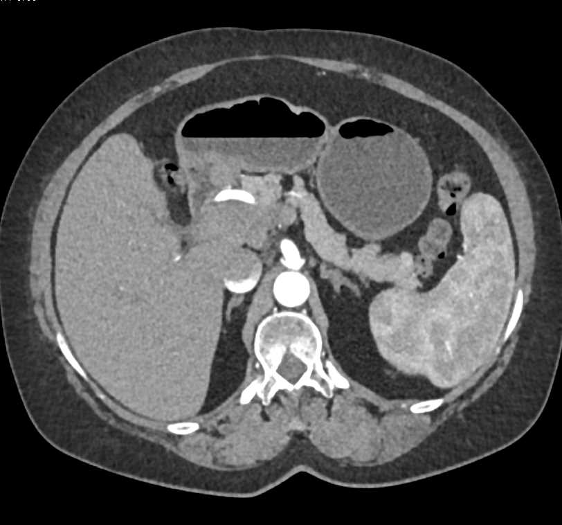 Carcinoma of the Head of the Pancreas - CTisus CT Scan