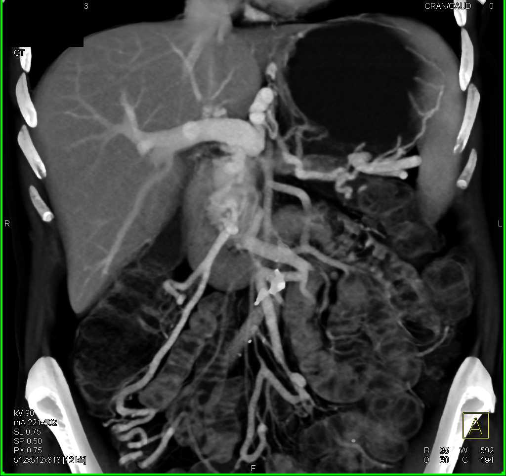 Carcinoma Body of Pancreas with Vascular Invasion - CTisus CT Scan