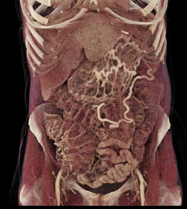 Carcinoma Body of Pancreas with Vascular Invasion - CTisus CT Scan