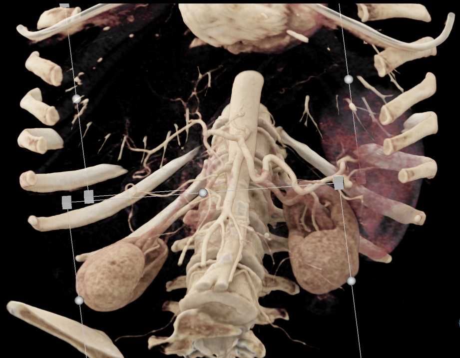Carcinoma Body of Pancreas with Vascular Invasion - CTisus CT Scan