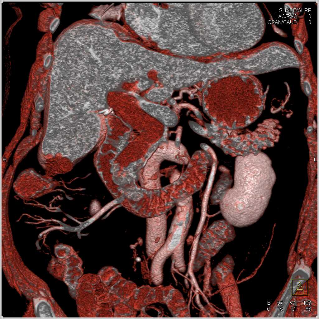Pancreas cancer with Dilated CBD - CTisus CT Scan