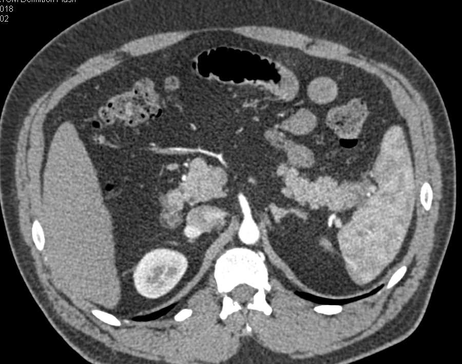 Carcinoma Tail of Pancreas - CTisus CT Scan