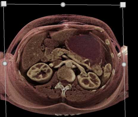 Carcinoma Tail of Pancreas - CTisus CT Scan