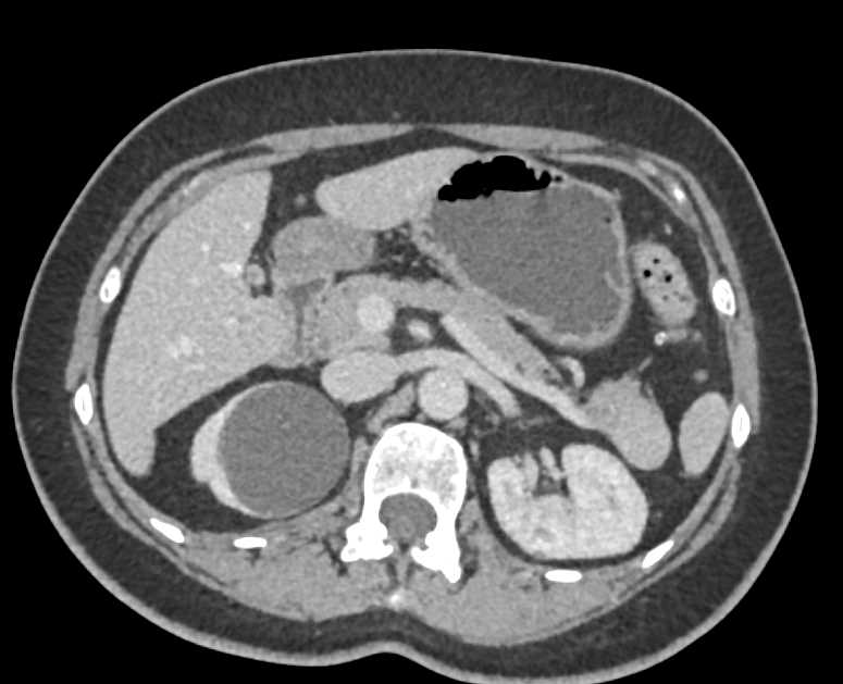 Splenule Tail of Pancreas Simulates a PNET - CTisus CT Scan