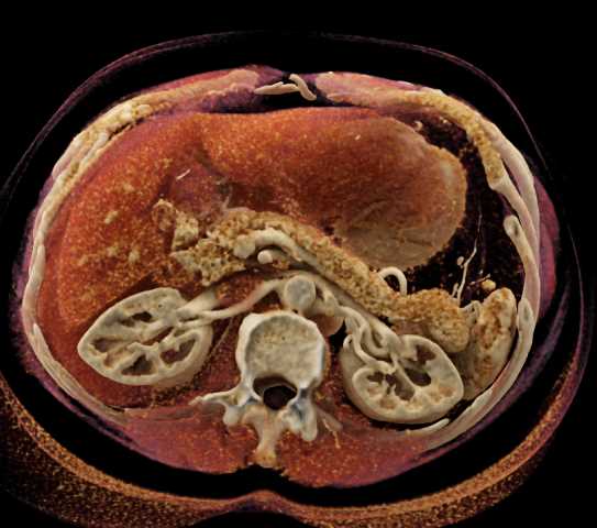 Splenule Tail of Pancreas Simulates a PNET - CTisus CT Scan