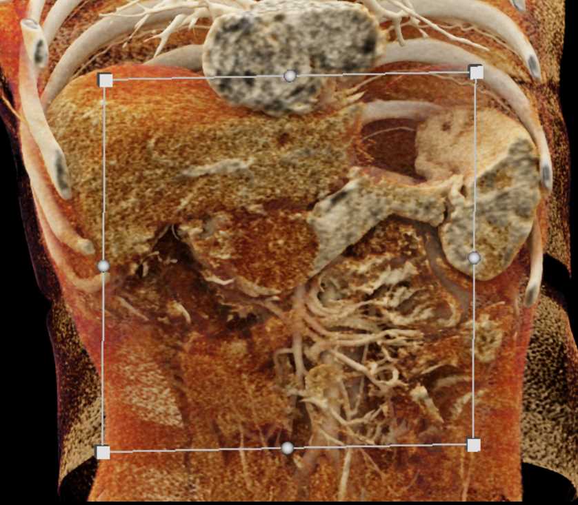 Serous Cystadenoma - CTisus CT Scan