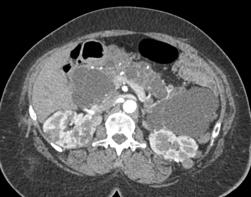 VHL with Renal and Pancreatic Cysts - CTisus CT Scan