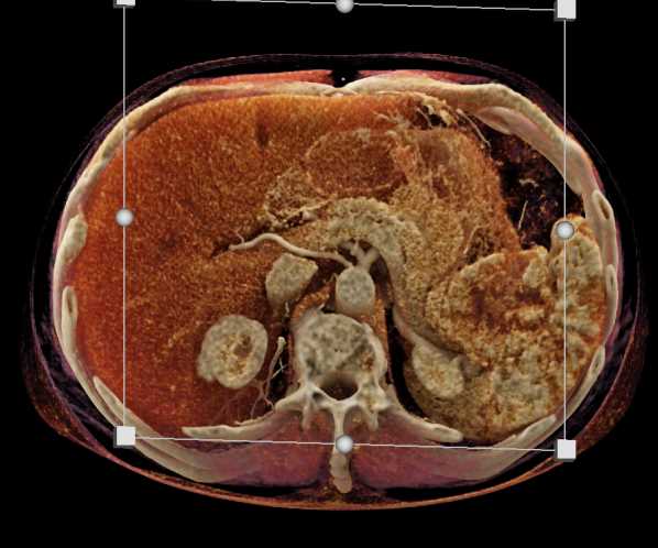 Carcinoma Tail of Pancreas - CTisus CT Scan