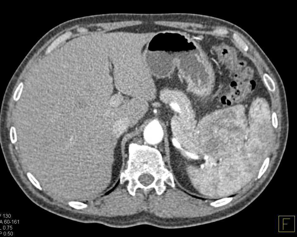 Carcinoma Tail of Pancreas - CTisus CT Scan