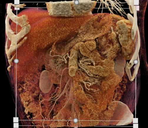 Carcinoma Tail of Pancreas - CTisus CT Scan