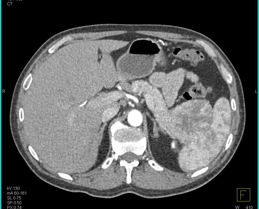 Carcinoma Tail of Pancreas Simulates a PNET - CTisus CT Scan
