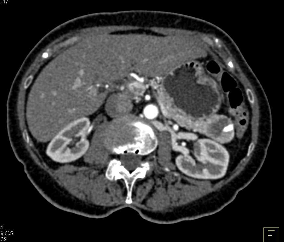 PNET Tail of Pancreas - CTisus CT Scan