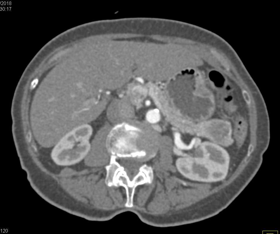 PNET Tail of Pancreas - CTisus CT Scan