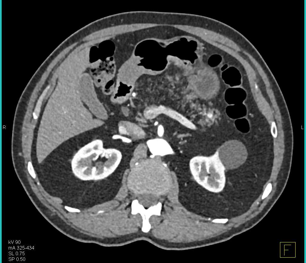 1 cm PNET Tail of Pancreas - CTisus CT Scan