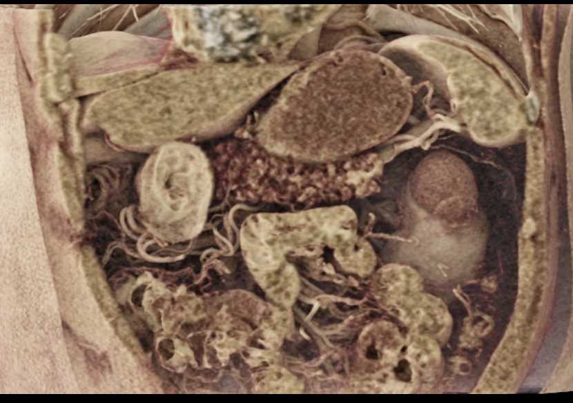 1 cm PNET Tail of Pancreas - CTisus CT Scan
