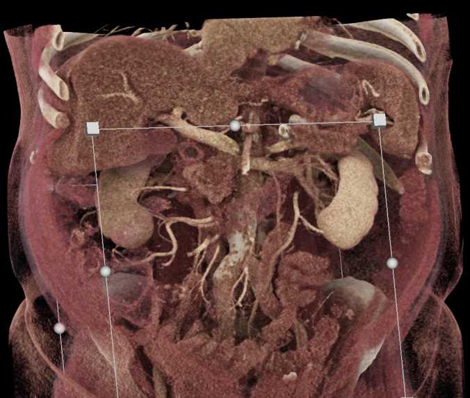 IPMN Head of Pancreas with High Grade Dysplasia - CTisus CT Scan