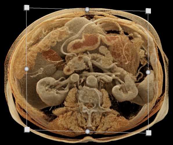IPMN Head of Pancreas with High Grade Dysplasia - CTisus CT Scan