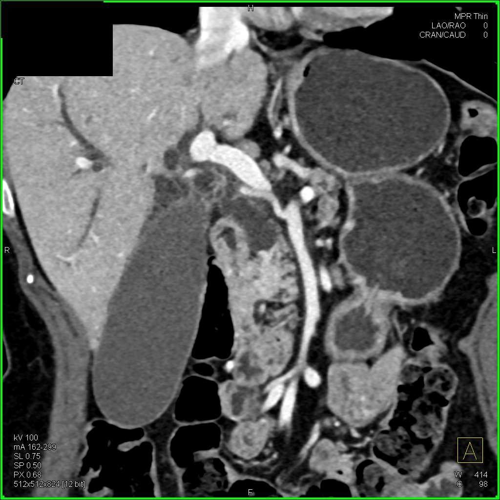 Ampullary Carcinoma - CTisus CT Scan