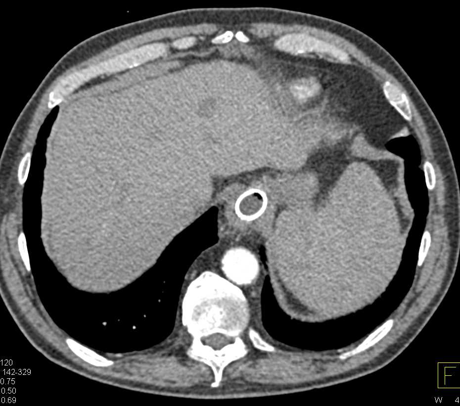 Infiltrating Pancreatic Adenocarcinoma - CTisus CT Scan